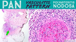 Polyarteritis nodosa amp leukocytoclastic vasculitis pattern Inflammatory Dermpath Basics [upl. by Yedoc46]