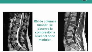 NeurorgsnetFractura lumbar por accidente deportivo [upl. by Herman140]