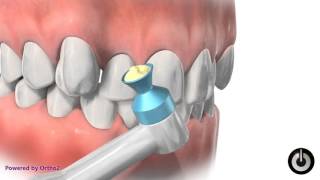 How braces are put on [upl. by Ttemme652]