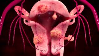 Uterine Fibroid Embolization Treatment [upl. by Rumit]