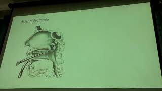 Amigdalectomía y Adenoidectomía  2da parte OTORRINOLARINGOLOGIA [upl. by Sheba]