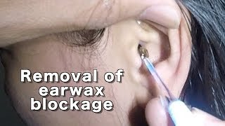 Dry Earwax Blockage Removal [upl. by Adler]