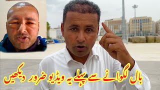 Must Watch Before Hair Transplant  Hair Transplant Complete Process and Final Results  Mubashir [upl. by Gnues]