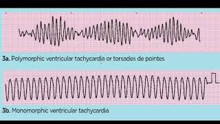 TORSADES DE POINTES 4TH YR [upl. by Ytiak452]