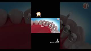 How to floss your bonded retainer after orthodontics [upl. by Everett]