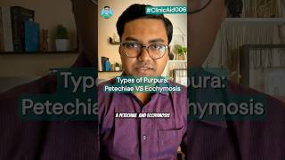 Types of Purpura Petechiae VS Ecchymosis for USMLE NEET PG NCLEX INICET [upl. by Eesdnil124]