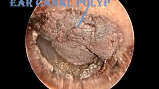 Dried Hemorrhagic Ear Canal Polyp Removal amp Cleaning [upl. by Omland]