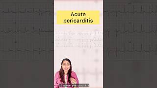 Acute pericarditis doctors pericarditis cardiology cardiologist echocardiagram ecg ecgc [upl. by Dwayne]