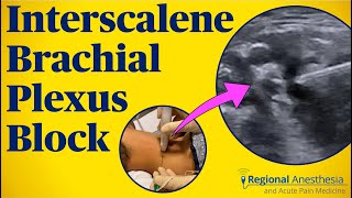 Interscalene Brachial Plexus Block [upl. by Buskus]