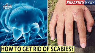 Scabies outbreak UK  Symptoms and how to get rid of [upl. by Nevins268]