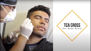 TCA Cross for Acne Scars Darker Skin Tone Ice Pick Scars [upl. by Kurt]