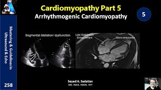 Arrhythmogenic Cardiomyopathy [upl. by Noseyt562]