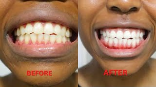 Teeth Whitening At Home Live Demo amp Instant Results 😱SHOCKED [upl. by Enitsud]