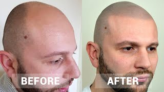 Scalp Micropigmentation Testimonial By Mark  Hairline Inc  Life Changing Results [upl. by Redep577]