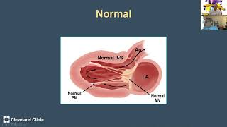 Hypertrophic Cardiomyopathy Anatomic Variants and Echocardiographic Pearls from Dr Harry Lever [upl. by Imuyam]