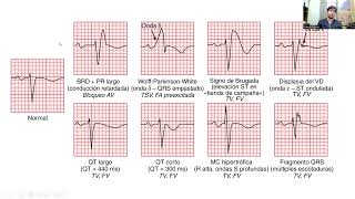 Cardiologia Diagnóstico y manejo de TAQUICARDIA VENTRICULAR [upl. by Hegarty]