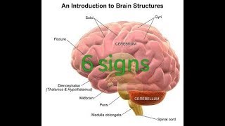 6 signs or symptoms of cerebral edema [upl. by Anehc]