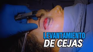 LEVANTAMIENTO de cejas CIRUGIA [upl. by Elberfeld901]