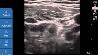 Ultrasoundguided CFNB [upl. by Modesty]