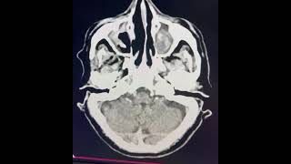 Acute left pontine infarct radiology viralshort viral viralshorts [upl. by Adiol]