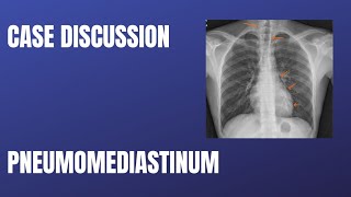 Case Discussion  Pneumomediastinum [upl. by Yaeger]