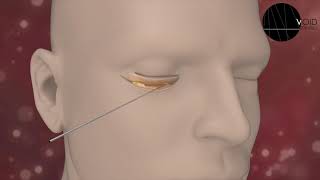 VOID Cleveland Clinic AD Blepharoplasty Medical Animation [upl. by Shipp]