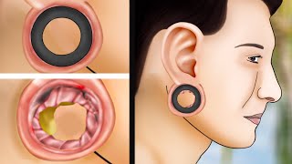 ASMR Treatment and cleaning of large swollen hole and smelly piercing 부풀어 오른 피어싱 구멍을 고름으로 청소하십시오 [upl. by Kartis]