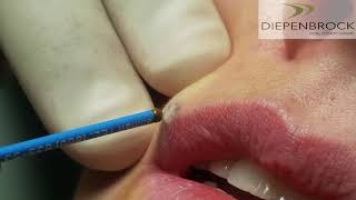 Mole Removal with Ellman RF [upl. by Erde453]