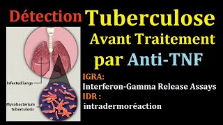 Dépistage de Tuberculose latent avant AntiTNF infection tuberculeuse pulmonaire IDR interféron Gamma [upl. by Eerehc]