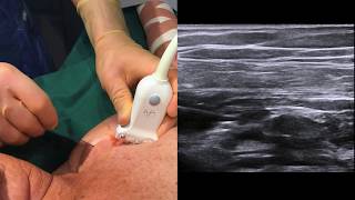 Ultrasoundguided infraclavicular brachial plexus block [upl. by Hareema]