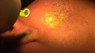 PIGMENTATION TREATMENT BY LASER At Radiance [upl. by Binetta]