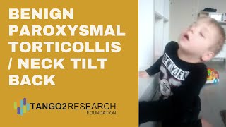 Benign Paroxysmal Torticollis Neck Tilt Back [upl. by Masha847]