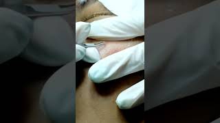 The Blackhead Extractions Breakthrough [upl. by Pembrook]