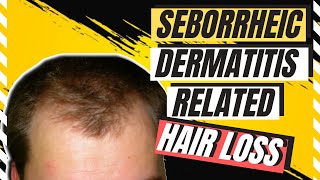 Scalp Seborrheic Dermatitis What It Is Symptoms and Treatment [upl. by Drucilla]