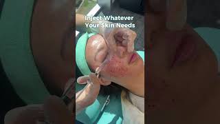 Mesotherapy Rejuvenate repair and refresh the skin [upl. by Mcfadden386]