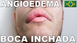 ANGIOEDEMA  BOCA INCHADA  TIREOIDITE HASHIMOTO [upl. by Dasie]