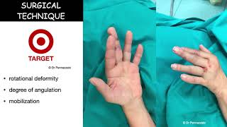 Percutaneous intramedullary screw fixation of metacarpal and phalangeal fractures [upl. by Iny]