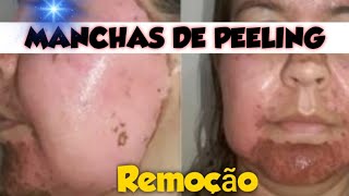 Como remover manchas de peeling [upl. by Peterman]