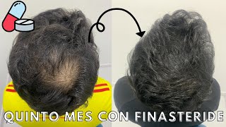 QUINTO MES con FINASTERIDE 💊 [upl. by Cody]