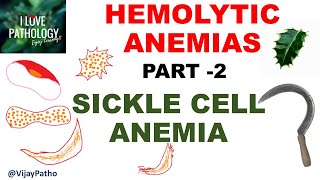 Hemolytic Anemias Part 2 SICKLE CELL ANEMIA Pathology [upl. by Giustina]