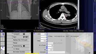 CT Scan angiography of the thoracic aorta SIEMEN  CLVT Động mạch chủ ngực [upl. by Aniled413]