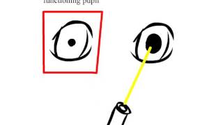 Reverse Afferent Pupillary Defect Positive and Negative [upl. by Gifford]