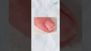 Nail Skin Peeling Home Remedies nails nailscare skincare tips health healthtips factsinhindi [upl. by Tiduj249]