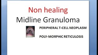 ENT Non healing Midline Granuloma compare Wegener Granulomatosis Diagnosis Treatment EBV [upl. by Oiragelo]