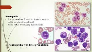 Practical Hematology 11 Morphology of Benign WBCs disorders [upl. by Akibma]