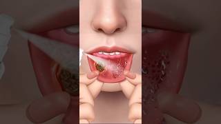 ASMR Remove lips Big Acne amp worm Maggot infection mouth care treatment 2d animation [upl. by Handler931]