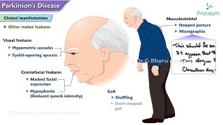 Parkinsons Disease🧠  Etiology  Pathophysiology  Clinical manifestations  Diagnosis  Treatment [upl. by Festatus664]