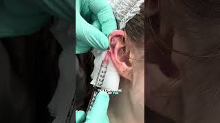 Shocking Ear Keloid Transformation  Before and After Revealed keloidtreatment keloids [upl. by Benedick]