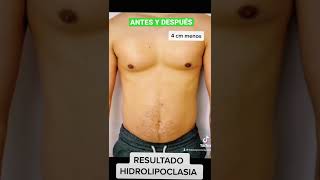 🤩🔥 Estos son los RESULTADOS de la HIDROLIPOCLASIA Antes y Después [upl. by Sirraj408]