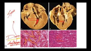 IM Cardiology 15 Cardiomyopathies Hypertrophic cardiomyopathy HCM [upl. by Consuelo]